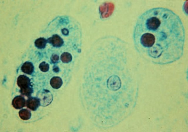 Entamoeba histolytica - parazit s fagocytovanými erytrocytmi