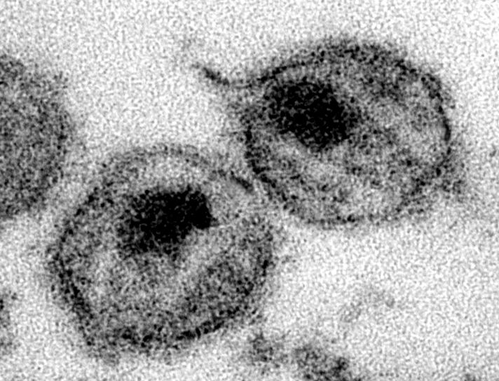 Virióny HIV v elektrónovom mikroskope
